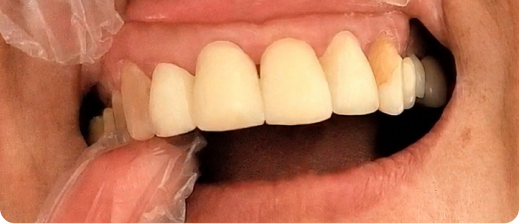 Smile after treatment 1