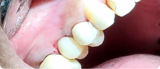 Smile after treatment 2