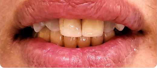 Smile after treatment 3