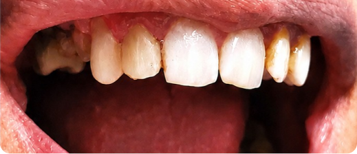Smile after treatment 4