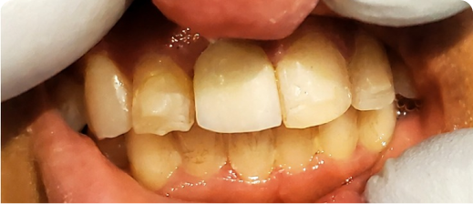 Smile before treatment 1