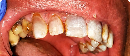 Smile before treatment 4